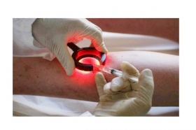 La rivoluzione nel trattamento delle vene varicose - www.trap.it